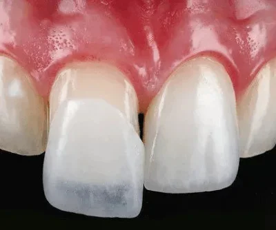 Invisalign Lite — traitement modéré à Laval