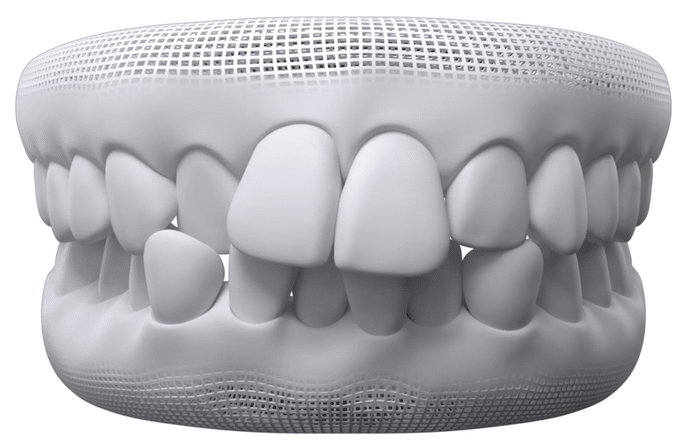Résultat Invisalign — cas 1