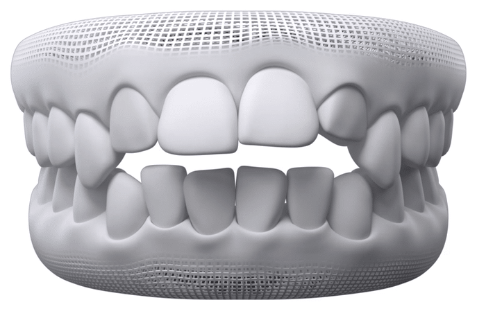 Résultat Invisalign — cas 2