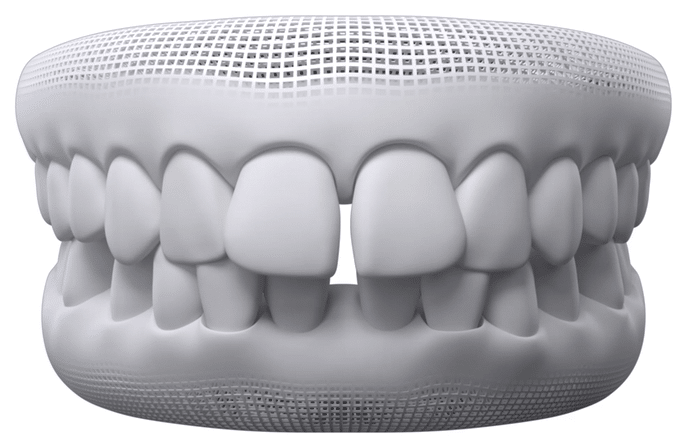 Résultat Invisalign — cas 3