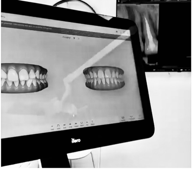 Consultation Invisalign à Laval — devis personnalisé