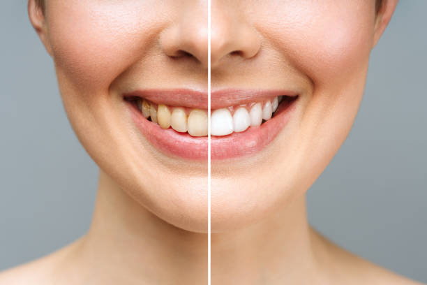 Invisalign Full — traitement complet à Laval