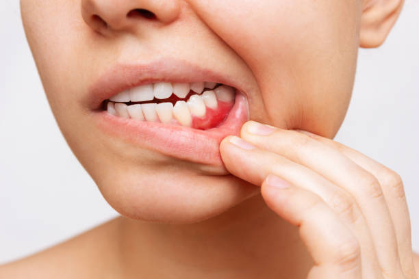 Invisalign Teen — pour adolescents à Laval