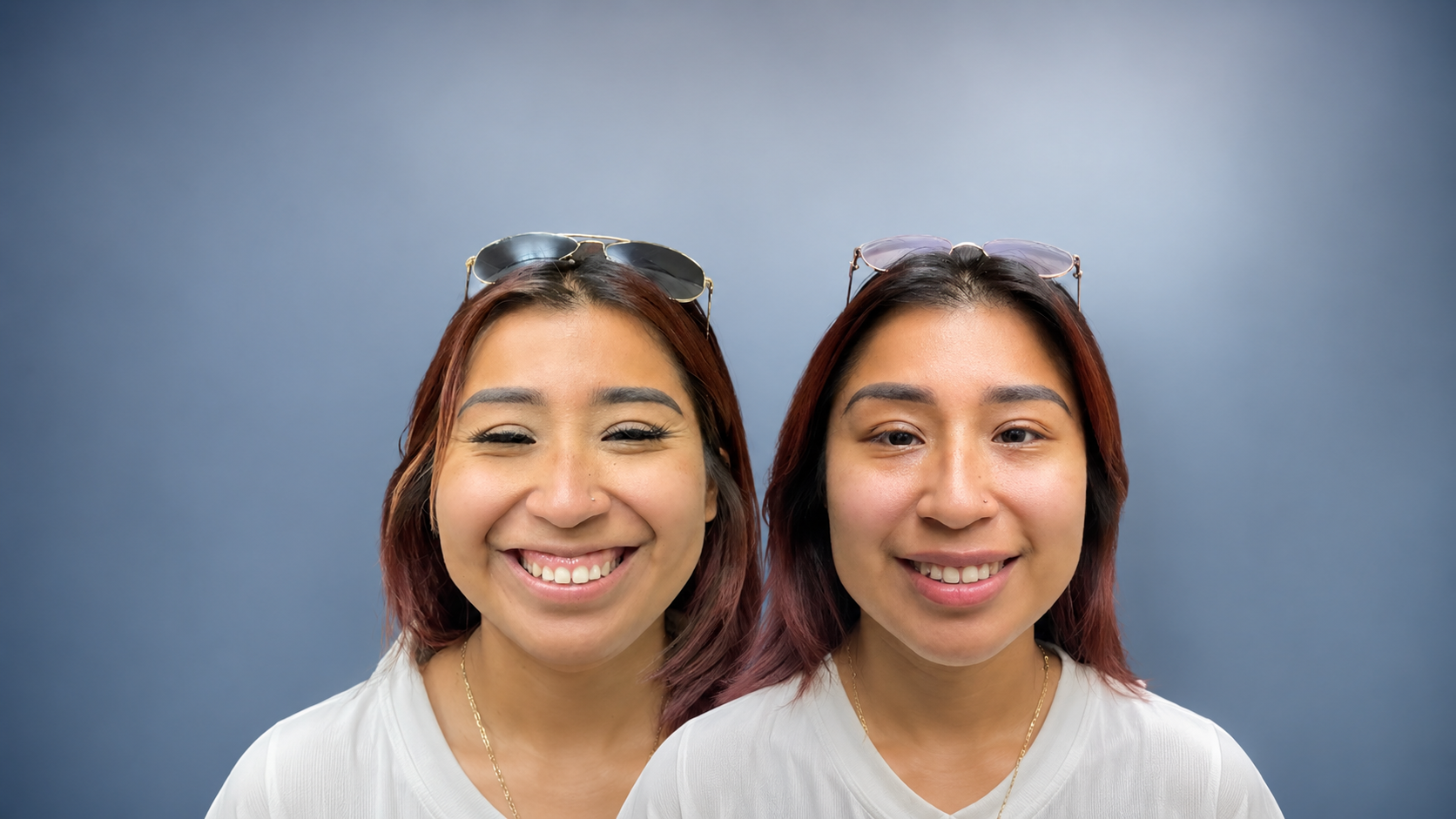 Bruxisme et neuromodulateur — Smile Boutik Laval